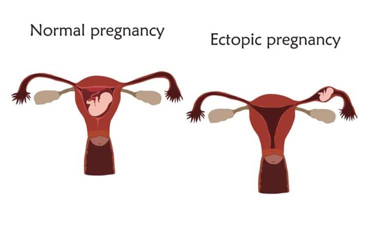 Intrauterina o extrauterina?